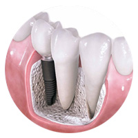 dental-implants-in-mexico